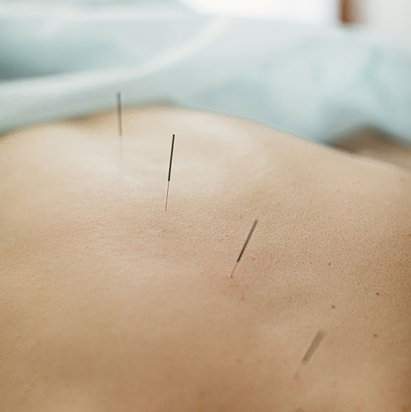 Acupuncture services in Lehi, UT