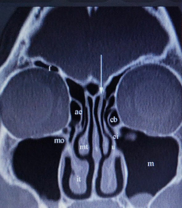 Deviated Septum